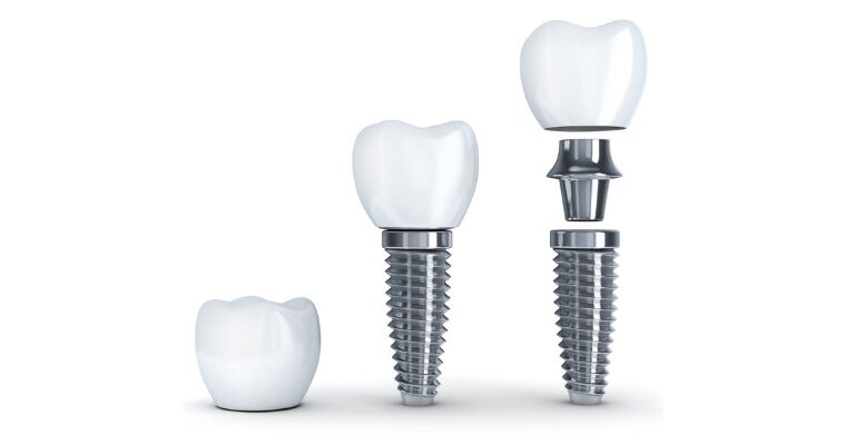 The three components of a dental implant